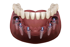 orthosquare invisible aligners